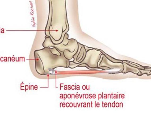 Pine calcanéenne semelle deals